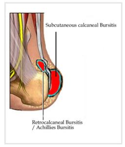 Suffering from Retrocalcaneal Bursitis? The OSMO Patch is a natural, efficient method to reduce the swelling and relieve the pain at the back of the heel. Achilles Bursitis, Heel Bursitis, Achilles Pain, Joints Pain Remedy, Pain Relief Remedies, Back Pain Remedies, Ankle Pain, Foot Pain Relief, Joints Pain Relief