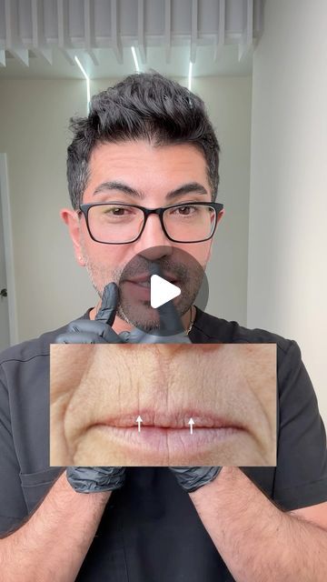 Sirak Darbinian, MD on Instagram: "How to get rid of Smokers Lines …#botox #smokerslines #filler" How To Fix Smokers Lines, Smokers Lines, Beauty Treatments, Health And Wellness, Lashes, Lips, Health, Beauty, Instagram