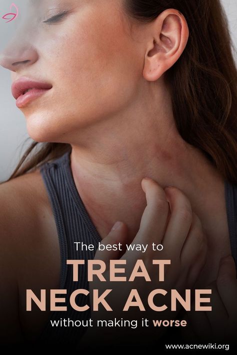 The best way to treat neck acne without making it worse Hair usually frequents certain areas of your body while forsaking other parts, for instance your head, upper lip, chin, chest, parts of your arms and legs and so on. Likewise, acne also tends to appear on certain parts of your body but not others. In this article we will go on a mapping survey of the areas where acne breakouts always take place, why it is so and how to prevent it from appearing. Acne breakouts on the neck This type of a... Jawline Acne, Cheek Acne, Neck Acne, Chin Acne, Bad Acne, Flaking Skin, Pore Strips, Types Of Acne, Acne Breakout