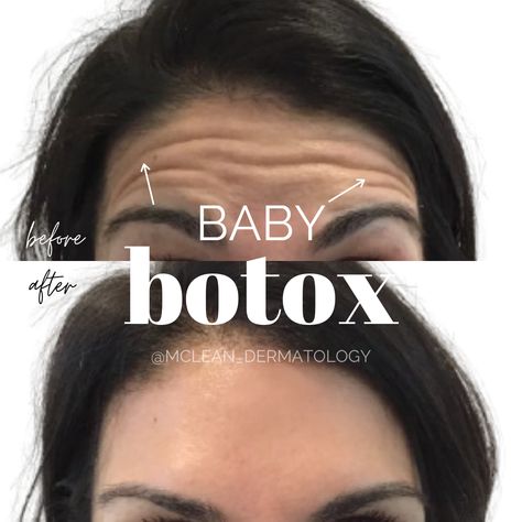 Forehead Botox Units, Baby Botox Before And After, Before And After Botox Pictures, Botox Before After, Botox Forehead, Botox Results, Facial Aesthetic, Disney Eyes, Botox Before And After