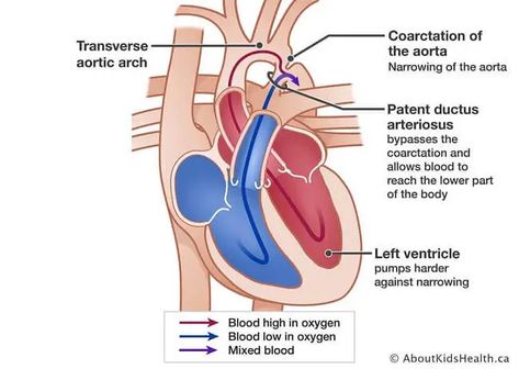 Overview of Coarctation of the aorta The aorta is the longest arterial system within your body. It carries rich oxygenated blood to your entire body. Aorta Arterial System, Coarctation Of The Aorta, Bicuspid Aortic Valve, Patent Ductus Arteriosus, Atrial Septal Defect, Mitral Valve, Pressure Headache, Heavy Sweating, Congenital Heart Defect