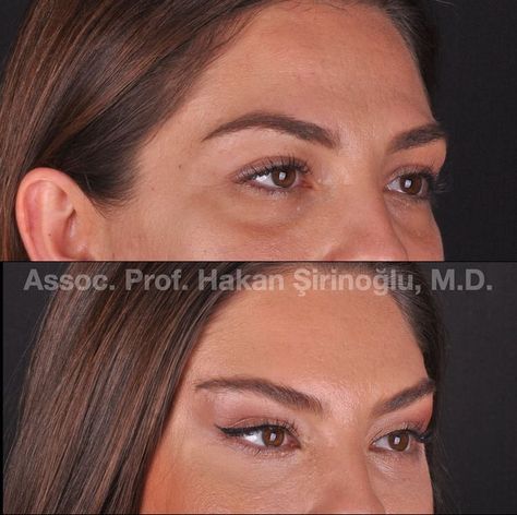 Cat Eye Surgery Before And After, Blethoplasty Before And After, Armonizacion Facial, Botox Eyes, Makeup Brushes Amazon, Brow Lift Surgery, Jaw Reduction Surgery, Mommy Makeover Surgery, Plastic Surgery Fail