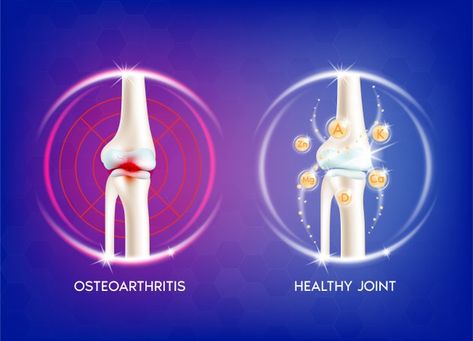 Human Bone Anatomy, Human Joints, Bone Anatomy, Anatomy Skeleton, Human Knee, Knee Health, Vitamin Therapy, Bones Design, Health Ads