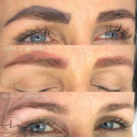 The most successful powder brows removal techniques explained in detail. #powderbrows #powderbrowsremoval #ombrepowderbrows #ombrepowderbrowsremoval Powder Eyebrows Permanent, Powder Brows Permanent, Powder Brows Before And After, Lighten Eyebrows, Powder Brows, Eyebrow Tattoo Removal, Red Eyebrows, Laser Removal, Burnt Hair