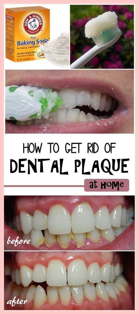 dental care tips Dental Plaque, Plaque Removal, Teeth Health, Best Teeth Whitening, Receding Gums, Oral Health Care, Overall Health, Tooth Decay, Natural Home Remedies