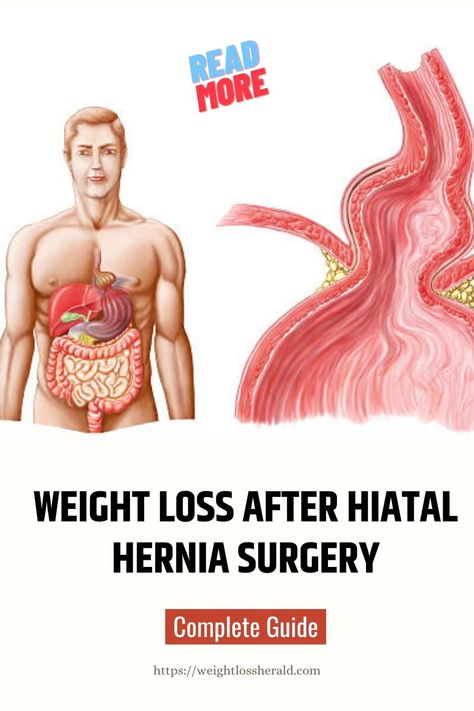 Weight loss after hiatal hernia surgery is important for managing symptoms and improving long-term outcomes. A healthy diet and gradual lifestyle changes can support healing and prevent complications. Consult with a healthcare provider for personalized recommendations, hernias in women, survival guide  #herniasinwomen Hiatal Hernias In Diet, Hiatal Hernias In Women Symptoms, Hiatal Hernias In Women Diet, Hiatal Hernias In Women, Hernias In Women, Hiatal Hernias, Soft Foods Diet, Gerd Diet, Diets For Women