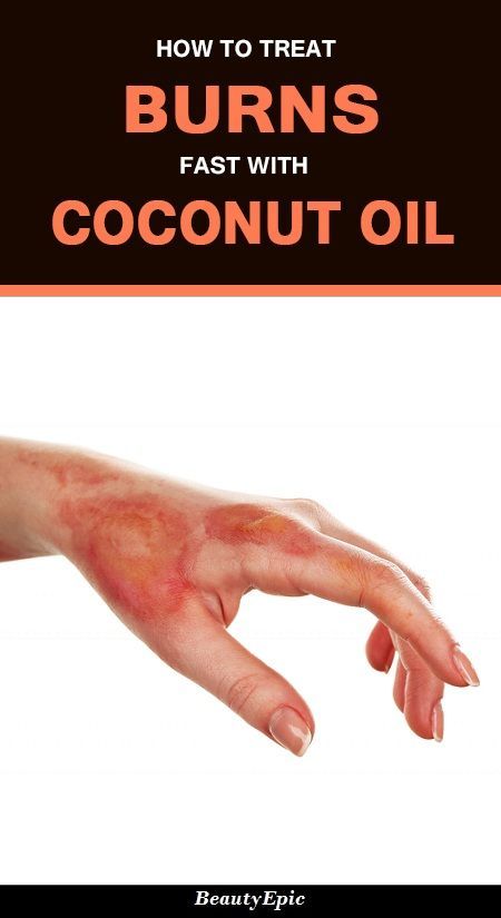 Coconut Oil For Burns, 2nd Degree Burns, Burn Ointment, Burn Remedy, Burn Relief, Coldsore Remedies Quick, Treat Burns, Skin Burns, Skin Natural Remedies