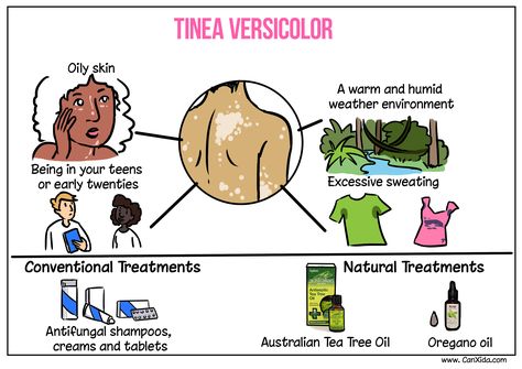 A condition which is often confused with vitiligo or other common conditions which affect the pigmentation of the skin but which is actually caused by a yeast infection is, Tinea Versicolor. This is also often referred to as Pityriasis versicolor, Dermatomycosis furfuracea or Tinea flava. Candida Supplements, Tinea Versicolor, Australian Tea Tree Oil, Candida Recipes, Candida Cleanse, Oregano Oil, Candida Diet, Natural Health Care, Excessive Sweating