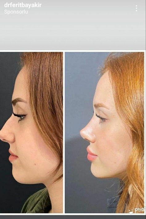 Nose Job Inspiration Natural, Eyes Surgery, Nose Ideas, Nose Plastic Surgery, Nose Surgery Rhinoplasty, Nose Fillers, Angel Skull, Nose Jobs, Rhinoplasty Nose Jobs