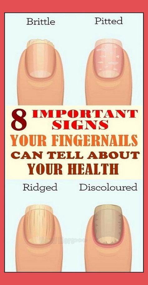 8 IMPORTANT SIGNS YOUR FINGERNAILS CAN TELL ABOUT YOUR HEALTH Nail Growth Faster, Nail Conditions, Recipe Hacks, Body Attack, Milky Nails, Tongue Health, John Brown, Brittle Nails, Nail Growth