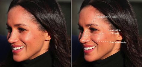 Meghan Markle generated a buzz right after the Royal Wedding. Everyone is talking about her lifestyle and appearance which led people to speculate some changes on her nose. With that, let's analyze her nose from a plastic surgeon's perspective. Megan Markle Nose, Meghan Markle Nose Job, Meghan Markle Plastic Surgery, The Royal Wedding, Big Noses, Nose Job, Royal Weddings, Plastic Surgeon, The Duchess