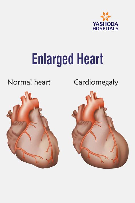 Enlarged Heart, Heart Valve, Heart Rhythm, Lung Transplant, Heart Valves, Normal Heart, Heart Muscle, Heart And Lungs, Heart Conditions