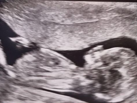 14 week scan - reversal of vasectomy by Mr Duncan Harriss Girl Ultrasound, Ramzi Method, Twins Ultrasound, Fetal Ultrasound, Baby Ultrasound Pictures, Nub Theory, 20 Week Scan, Vasectomy Reversal, Announcement Photoshoot