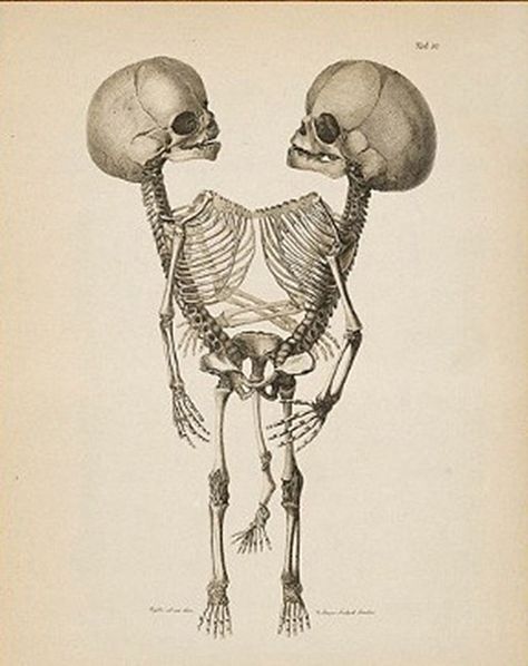 vintage medical illustration Siamese Twins, Skeleton Drawings, Conjoined Twins, Skeleton Illustration, Vintage Medical, Medical Art, Arte Inspo, Scientific Illustration, Medical Illustration