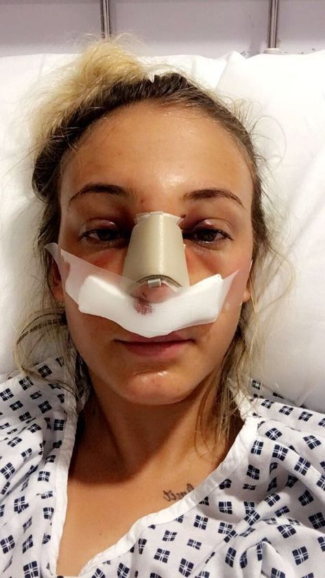 Student's new £5,000 nose broken in vicious high-heel attack while sat on nightclub toilet 'by old school friend' - Mirror Online Nose Plastic Surgery, Holly Pictures, Broken Nose, Nose Job, Plastic Surgery, Getting Things Done, Night Club, Surgery, Old School