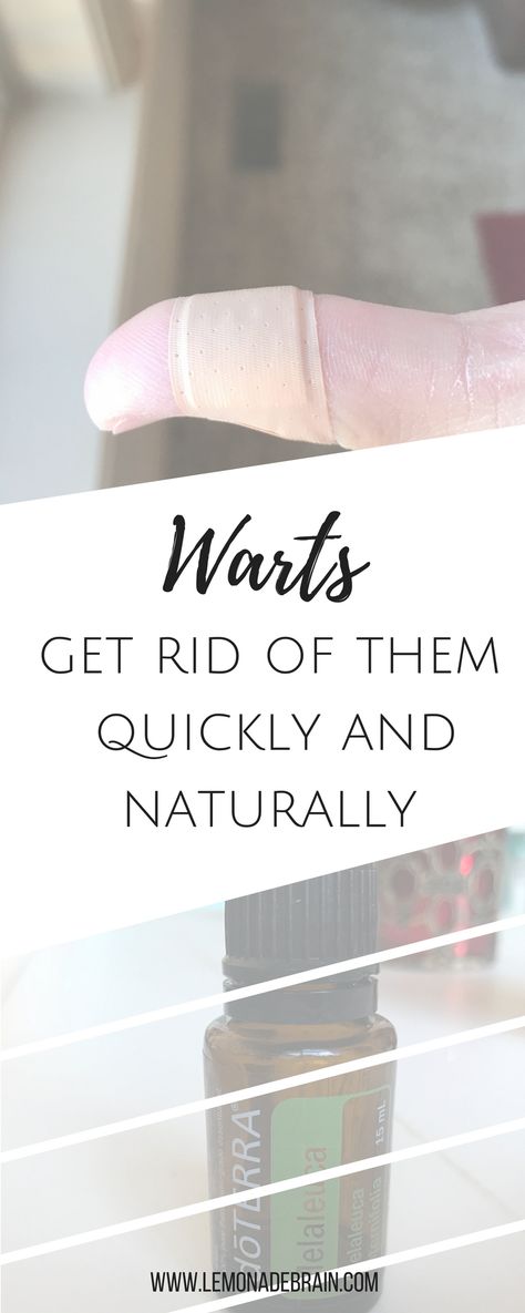 Warts: get rid of them quickly, naturally and painlessly So, every so often I become a witch and what I mean by that is, I suddenly develop a wart on one of my fingers or the bottom of my feet. And. They. HURT! Warts are the worst. Not to mention, How To Get Rid Of Warts On Fingers, How To Get Rid Of A Wart On Your Finger, Wart Remedies For Kids, How To Get Rid Of Warts On Hands, Wart Remedies, What Causes Warts, Warts On Hands, Warts On Face, Get Rid Of Warts