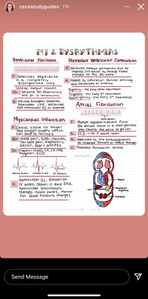 Cardiac Pathology, Cardiovascular Nursing, Nurse Notes, Exam Notes, Nclex Prep, Nursing Exam, Atrial Fibrillation, Medical School Essentials, Circulatory System