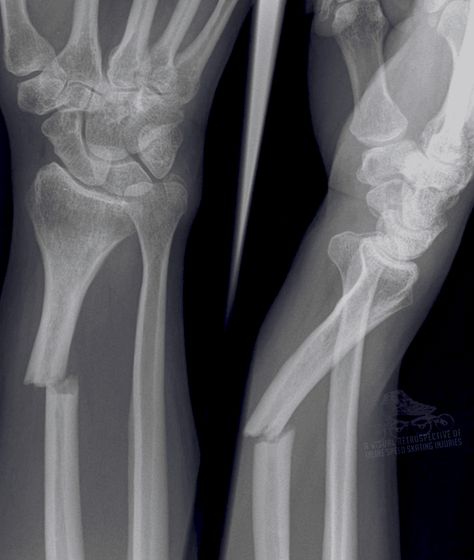 Fractured Ulna / Recovery Time is about 8 Weeks – #wrist #fracture #xray #inlinespeedskating #injury #bones #broken Broken Bones X Ray, Wrist Xray, Deku Aesthetic, Wrist Fracture, Eddie Kaspbrak, X-ray Images, Ap Drawing, Bone Fracture, Career Day