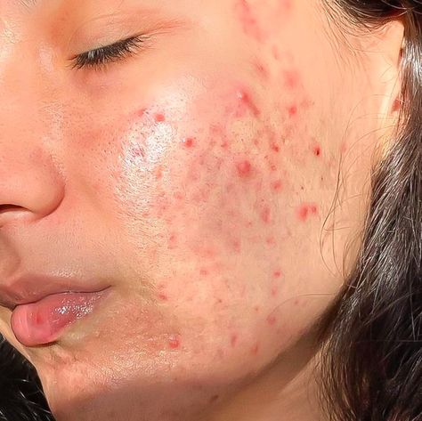 Acne Photoshoot, Acne Photography, Acne Aesthetic, Acne Photos, Girl With Acne, Acne Positivity, Skin Positivity, Best Dark Spot Corrector, Face Mapping Acne