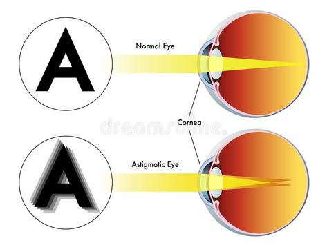 Astigmatism Eye, Optician Training, Optometry Education, Eye Anatomy, Eye Facts, Lasik Surgery, Vision Therapy, Laser Eye, Eye Exercises