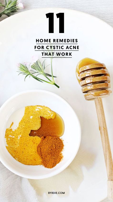 How to get rid of cystic acne Get Rid Of Cystic Acne, Severe Acne Remedies, Treating Cystic Acne, Cystic Acne Remedies, Chest Acne, Painful Acne, Acne Beauty, Acne Tips, Back Acne