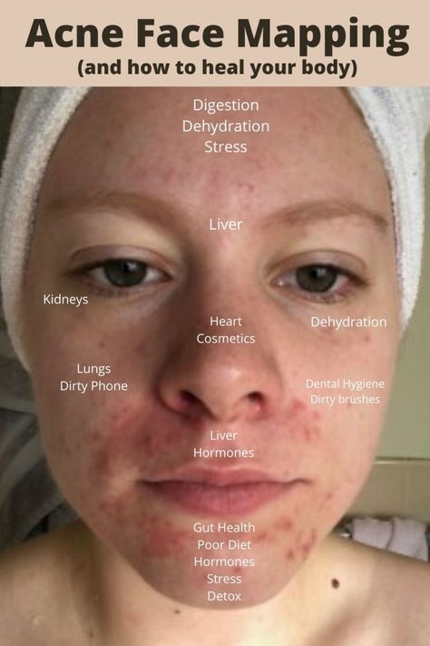 Face Mapping - What Your Acne Is Saying About Your Health | Simply Noel Face Acne Remedies, Acne Face Map, Face Map, Cause Of Acne, Cystic Acne Remedies, Face Mapping Acne, Acne Overnight, Bad Acne, Face Mapping