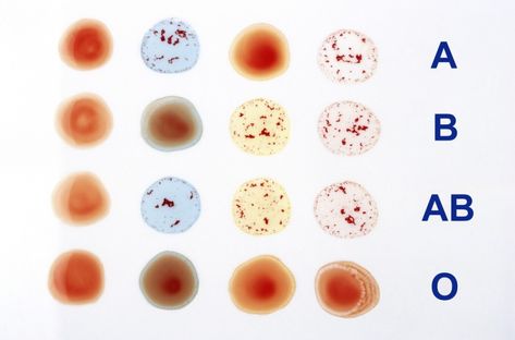 How to Determine Blood Type | Spot on: A blood-type test shows four blood-type reactions to antibody ... Medical Laboratory Technician, Blood Group, Technology Careers, Laboratory Technician, Medical Laboratory Science, Blood Groups, Blood Bank, Phlebotomy, Medication Management