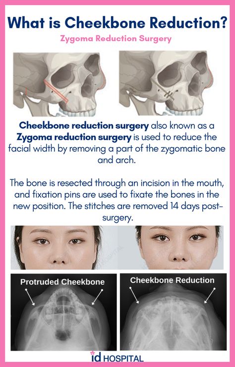 Zygoma Reduction, Cheekbone Reduction, Eye Bag Surgery, Dream Nose, Plastic Aesthetic, Crooked Face, Natural Contouring, Face Plastic Surgery, Facial Aesthetic