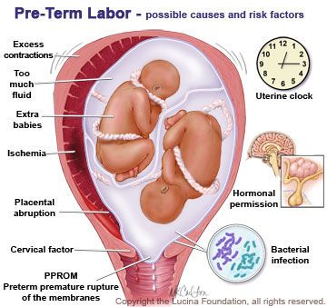 "Extra babies". Yeah that's a curve ball. Good summary - risk for preterm labor >>> Pre-Term Labor Diagram Newborn Nursing, Child Nursing, Preterm Labor, Ob Nursing, Nursing Care Plan, Neonatal Nurse, Nurse Rock, Medical School Essentials, Nursing Tips