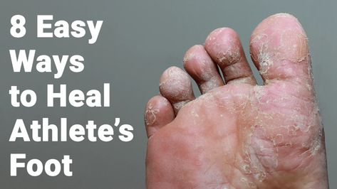 8 Easy Ways to Heal Athlete’s Foot Foot Fungus Remedies, Nail Remedies, Natural Antifungal, Ways To Heal, Nail Fungus Remedy, Fungal Nail, Athletes Foot, Peeling Skin, Fungal Infection