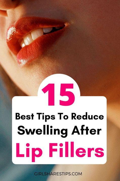 Post Lip Filler Care, Bruising After Lip Filler, Lip Fillers Bruising, Lip Filler Swelling Day By Day, Lip Filler After Care Instructions, Lip Injections Before And After 1ml, Lip Threading Before And After, Lip Filler Journey, Lip Filler Healing Stages