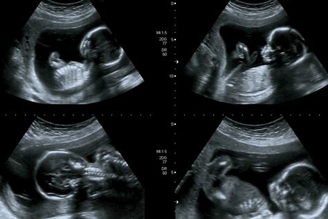 Third Month Pregnancy: Baby Development, Ultrasound And Exercises To Do 3 Month Ultrasound, 3rd Month Pregnancy, Baby Ultrasound Pictures, Third Month Of Pregnancy, Chromosomal Abnormalities, Pregnancy Ultrasound, Baby Ultrasound, Ultrasound Pictures, Pregnancy Hormones