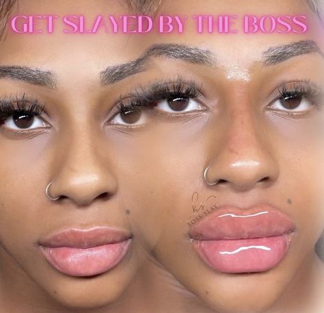 Bratz Lip Fillers, Lip Blushing Black Women, Filler Black Women, Lip Fillers Inspiration, Lip Filler Black Women, Filler Inspiration, Bestie Photoshoot, Under Eye Fillers, Botox Lips