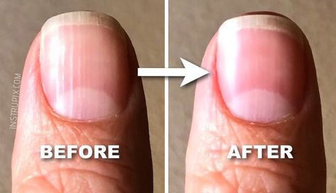 What Those Vertical Lines On Your Nails Mean About Your Health Vertical Line Nails, Vertical Lines On Nails, Lines In Nails, Vertical Nail Ridges, Nail Ridges, Nail Tape, Lines On Nails, Striped Nails, Vertical Lines