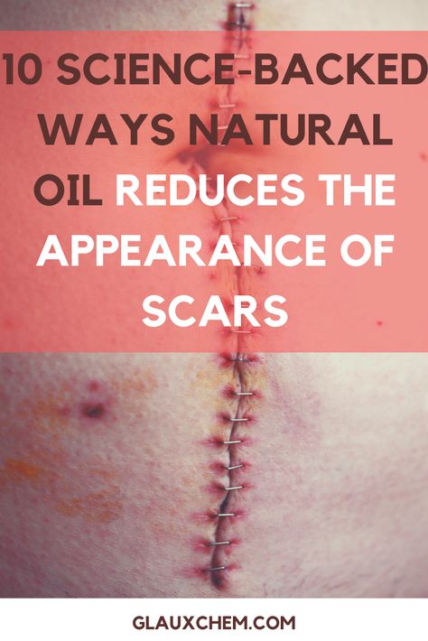 Scar Healing Remedies, Getting Rid Of Scars, Scar Remedies, Oils For Scars, Facial Scars, Lighten Scars, Rid Of Blackheads, Essential Oils For Skin, Get Rid Of Blackheads