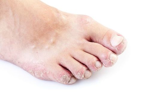 Athlete’s foot, also known as tinea pedis,is a fungal infection affects feet’s skin.Here are effective ways to use Apple Cider Vinegar for Athletes Foot Nail Disorders, Tinea Pedis, Foot Anatomy, Itchy Rash, Athletes Foot, Whole Food Diet, Skin Disorders, Fungal Infection, Foot Cream