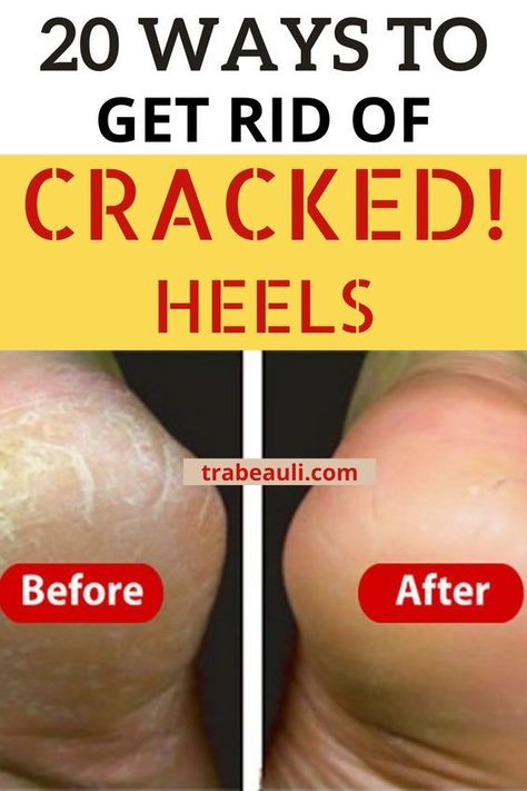 20 Ways to get rid of Cracked Heels How To Get Rid Of Heel Cracks, How To Get Smooth Heels, How To Get Rid Of Rough Heels, How To Make Feet Soft And Smooth, Smooth Feet Remedies, Dry Cracked Feet Remedy, Cracked Heel Remedy, Soft Feet Remedy, Cracked Feet Remedies