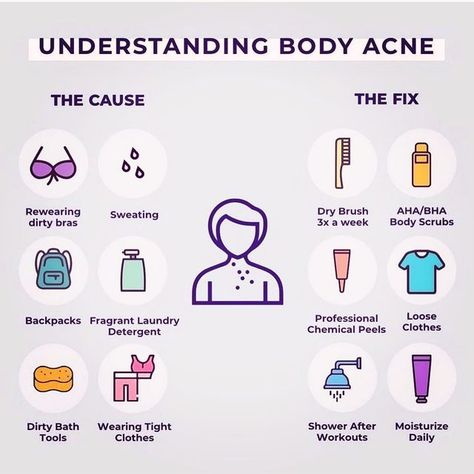 Body Pimples Remedies, How To Clean Back Acne, How To Get Rid Of Shoulder Acne, Shoulder Acne Causes, How To Remove Back Acne, Body Acne Tips, How To Get Rid Of Back Acne Fast, How To Get Rid Of Chest Acne, Chest Acne Causes