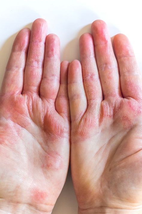 No, stress won’t exactly cause atopic dermatitis, the condition known as eczema. Learn why and read about other common misconceptions surrounding the rashlike condition. Contact Dermitis Hands, Atopic Dermitis Remedy, Rash On Hands, Arts Portfolio, Common Diseases, Heat Rash, Hand Protection, Medical Facts, Forehead Wrinkles