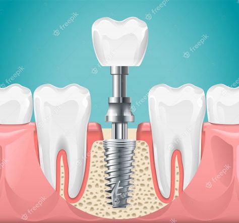 Free Dental Implants, Tooth Implant, Affordable Dental Implants, Dental Images, Dental Implant Procedure, Dental Posters, Best Dental Implants, Dental Implant Surgery, Bone Grafting