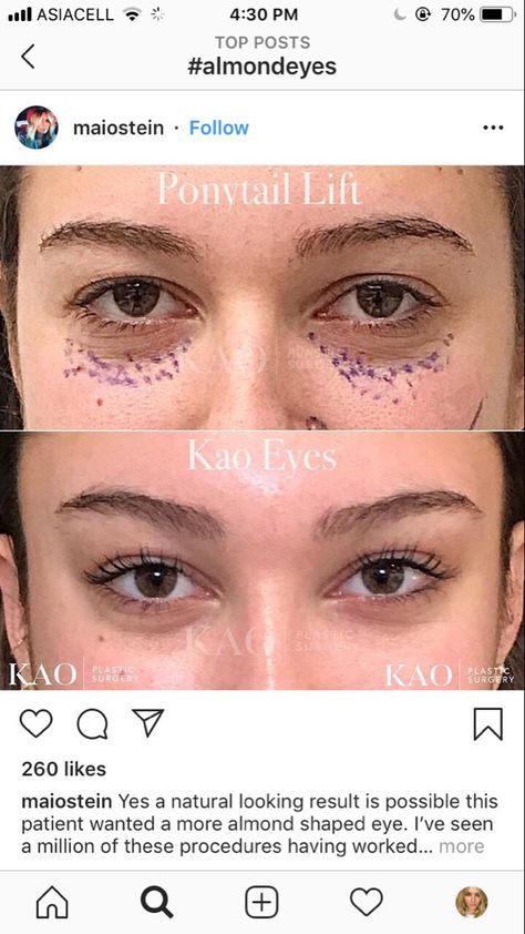 Eye Lift Surgery, Kylie Jenner Eyes, Face Asian, Face Plastic Surgery, Nose Surgery Rhinoplasty, Under Eye Fillers, Rhinoplasty Nose Jobs, Botox Lips, Botulinum Toxin