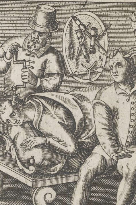 Trepanation: Our ancestors' idea of neurosurgery Historical Medical Illustrations, Medieval Medicine, Medical Pictures, Wellcome Collection, Medical Photos, Drilling Holes, Human Race, Medical Illustration, The Skull