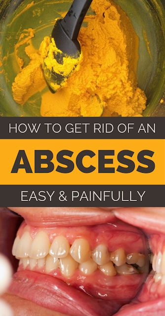 Gum Abscess, Dental Abscess, Abscess Tooth, Ayurveda Vata, Natural Medicines, Teeth Remedies, Stuffy Nose Remedy, Tooth Infection, Cold Remedy