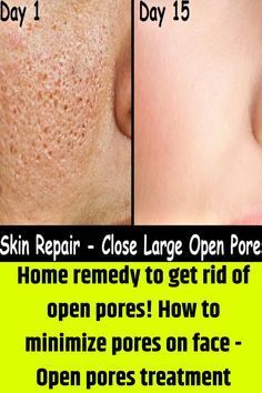 Big Pores On Face Remedies, Remedies For Pores On Face, Facial Pores Remedies, How To Minimize Pores Naturally, Remedies For Open Pores On Face, Get Rid Of Big Pores On Face, Face Pores Remedies, How To Treat Open Pores On Face, Reduce Open Pores On Face