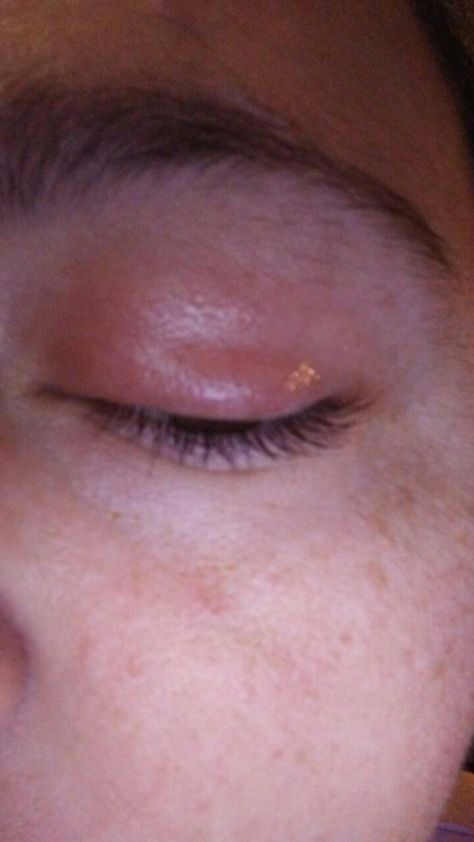 This was my eye infection before using my oils. And now my eye is back to normal. Http://mydoterra.com/wellness trio Eye Infections, Then And Now, And Now, Essential Oils