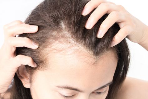 Traction Alopecia, Female Pattern Baldness, Women Science, Dramatic Hair, Stimulate Hair Follicles, Pattern Baldness, Skin Clinic, Hair Regrowth, Hair Restoration