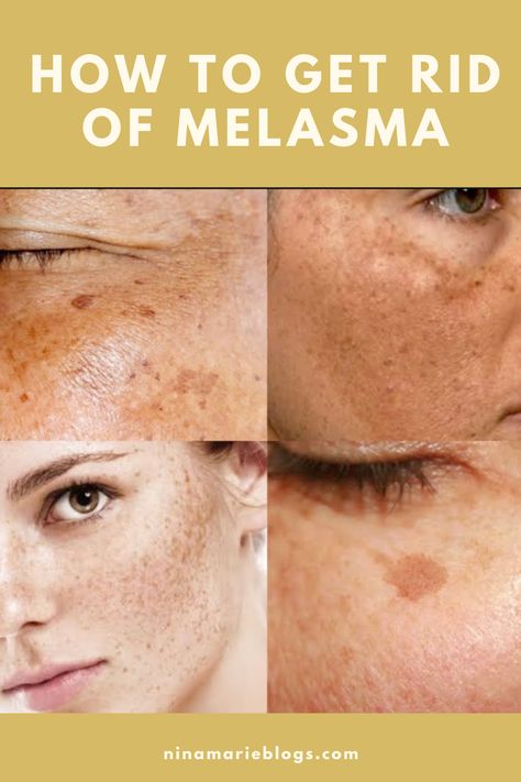 I am sharing tips on how to get rid of or lighten your melasma spots on your face or body. I understand how frustrating it can be to live with hyperpigmentation but you can remove + try to maintain with a few simple steps. Come check it out. Sunspots On Face, Sagging Cheeks, Dark Spots Remedies, Hyper Pigmentation, Skin Lightener, Dark Spots On Face, Scaly Skin, Brown Spots On Face, Dark Spots On Skin