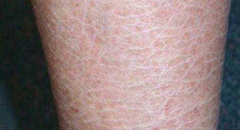 Ichthyosis Vulgaris-"fish-scale disease" occurs when your skin doesn't shed its dead skin cells Dry Skin Legs, Ichthyosis Vulgaris, Dry Scaly Skin, Dry Legs, Scale Skin, Skin Care Routine For 20s, Extremely Dry Skin, Dry Flaky Skin, Scaly Skin