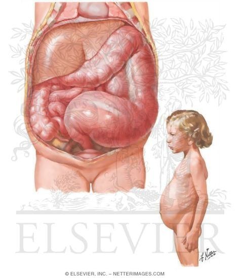 Hirschsprung's disease is a blockage of the large intestine due to improper muscle movement in the bowe ribbonlike stool-failture of innervation of gi tract around 5-12 weeks gestation Hirschsprungs Disease, Nursing School Prep, Nursing Study Tips, Newborn Nursing, Pediatric Medicine, Pediatric Nurse Practitioner, Muscle Movement, Nursing Board, Nursing Assessment