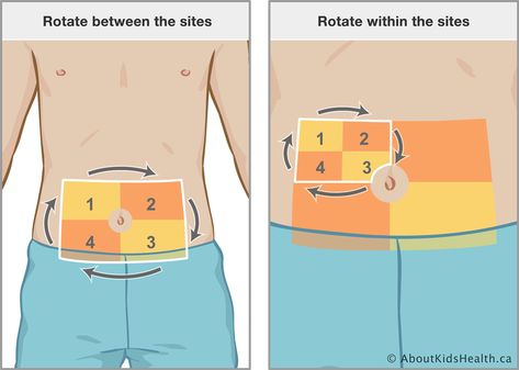 Insulin Injection Sites, Physical Health, Care Products, Health Care, I Hope, Health